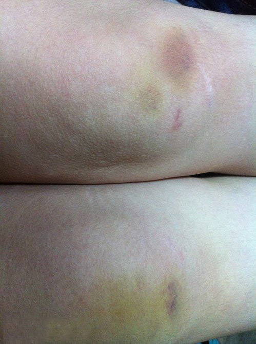 妹子，你的腿伤的不轻啊